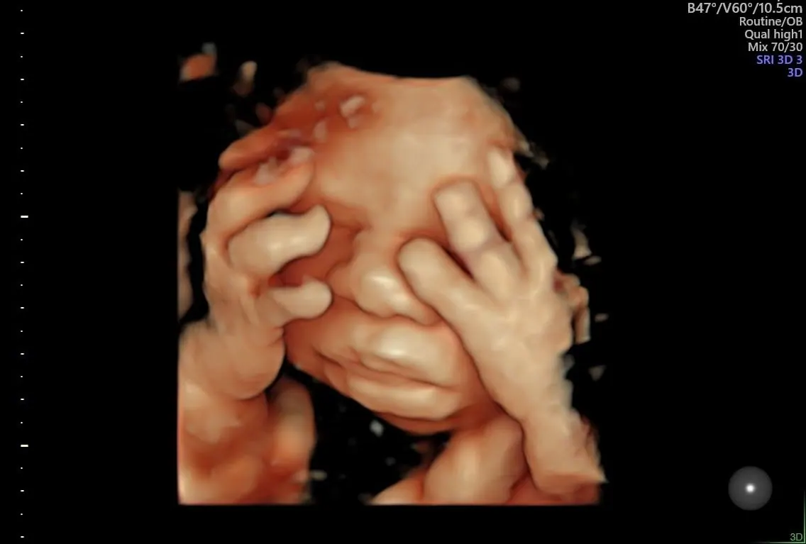 Ricostruzione ecografica 3D del feto.