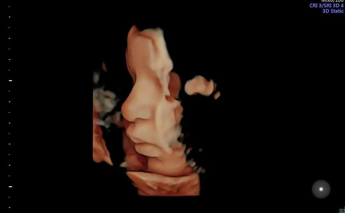 Ricostruzione ecografica 3D del feto.