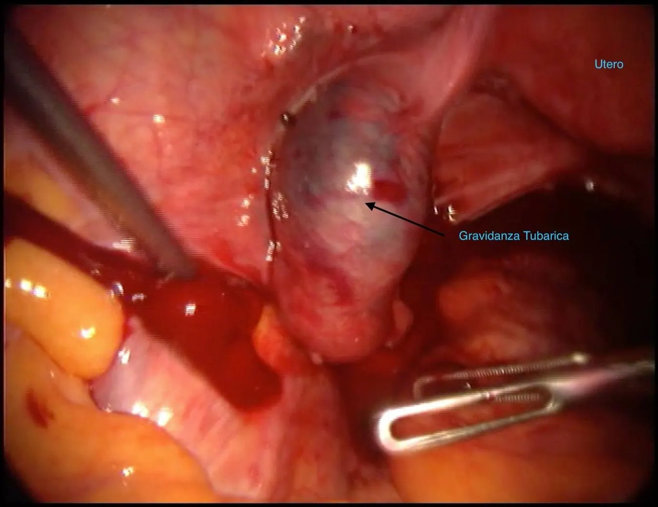 Gravidanza tubarica osservata in laparoscopia.