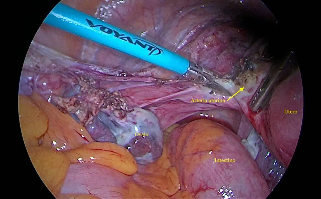 Identificazione e trattamento dei vasi uterini.