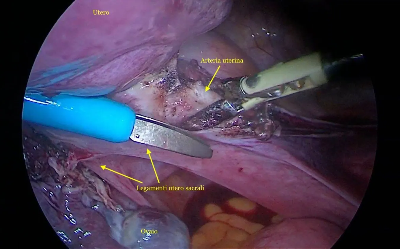 Fase di separazione dell’utero.