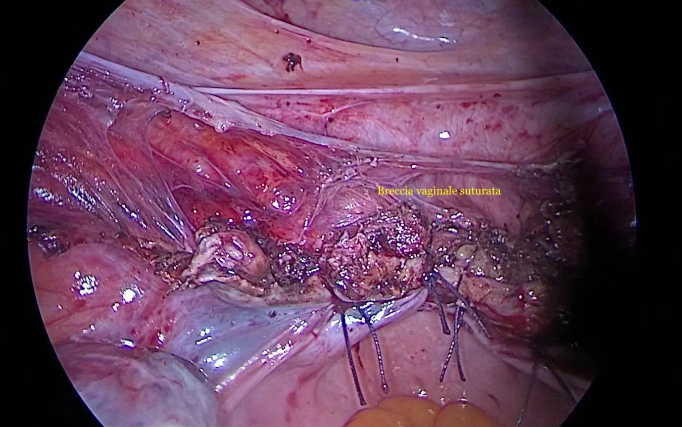 Sutura della cupola vaginale.