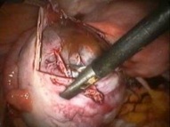 Immagine di una cisti endometriosica dall’archivio originale.
