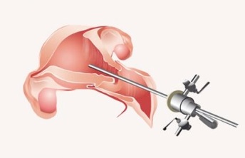 Isteroscopia: illustrazione recuperata dal vecchio sito.