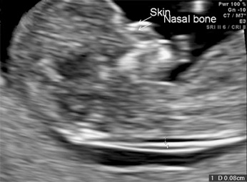 Profilo fetale e osso nasale: immagine dal vecchio sito