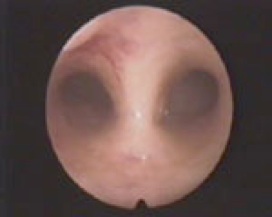 Illustrazione originale di utero setto.